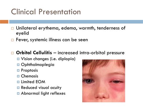 Ppt Periorbital Vs Orbital Cellulitis Powerpoint Presentation Free