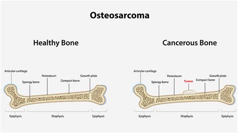 Osteosarcoma In Children - Symptoms And Treatment