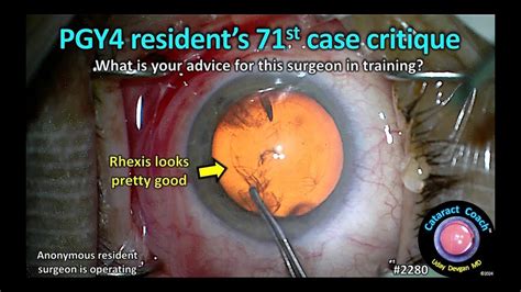 Cataractcoach Pgy Resident S St Cataract Case Critique Youtube