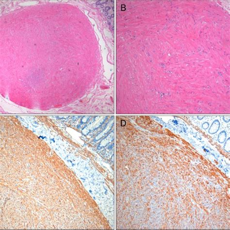 Histologic Findings H E Showing Well Circumscribed Nodule Arising