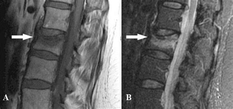 Osteoporotic Vertebral Compression Fracture Spine Orthobullets