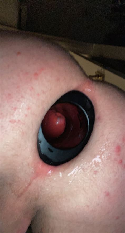 XXL MEO 24 7 Anal Stretching Ring 15 Pics XHamster