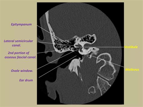 Presentation1.pptx, radiological anatomy of the petrous bone. | PPT