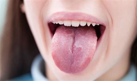 What Is Anemia Tongue Symptoms Causes And Effects Flash Uganda Media