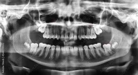 Panoramic radiography (orthopantomography) by means of X-rays showing ...