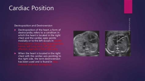 Fetal Echocardiography Basics And Advanced