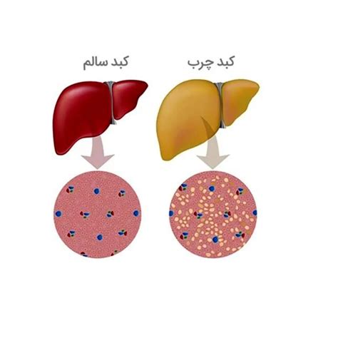 کبد چرب چه علائمی دارد و چگونه درمان می شود؟