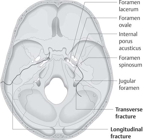 Types Of Temporal Bone Fracture