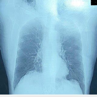 Chest X Ray Revealed Diffuse Pulmonary Edema Bilateral Interstitial