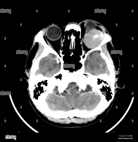 Orbital tumour, CT scan Stock Photo - Alamy