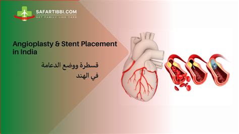 Angioplasty And Stent Placement A Comprehensive Guide