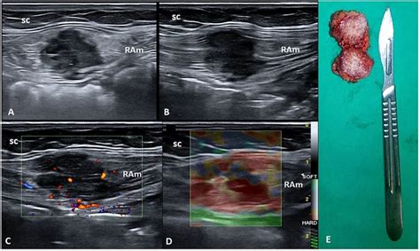 Short A And Long B Axis B Mode Ultrasound US Images Show The