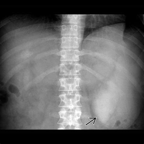 Splenomegaly And Hypersplenism Radiology Key