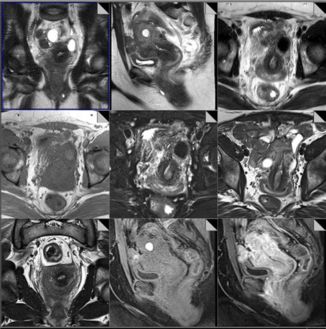 Mri Of Pelvis