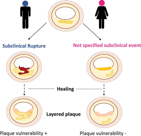 Sex Differences In Coronary Atherosclerotic Phenotype And Healing