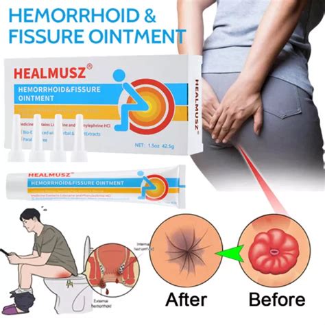 Haemorrhoids Treatment Cream Hemorrhoid Piles Anal Fissure Prolapse Cream Gel Uk Picclick Uk