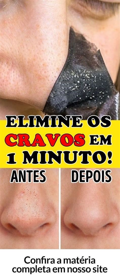 Dicas Caseiras Para Eliminar Cravos Do Rosto Passo A Passo