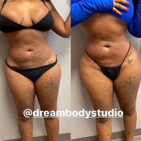 Dreamsculpt Non Surgical Lipo On Instagram “how Did I Achieve These