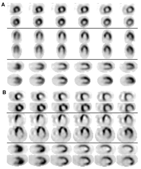 A Dual Isotope Dipyridamole 99m Tc Tetrofosmin Top Images In Each