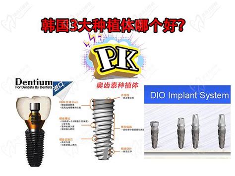 千元左右的韩国种植牙品牌中排名前三的登腾、dio和奥齿泰哪个更好？皓齿口腔网