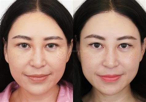 Masseter Botox Before And After Gallery At Sovereign Skin In Toronto