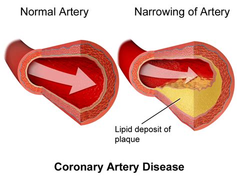 High Cholesterol Diet (UPDATE: Jul 2018) | 13 Things You Need to Know