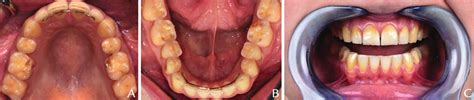 Initial photographs. A, Maxillary arch. B, Mandibular arch. C, Frontal... | Download Scientific ...