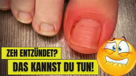 Nagelbettentz Ndung Am Gro En Zeh Captions Quotes