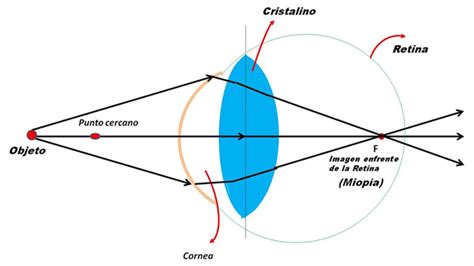 Aplicación De Lentes Divergentes