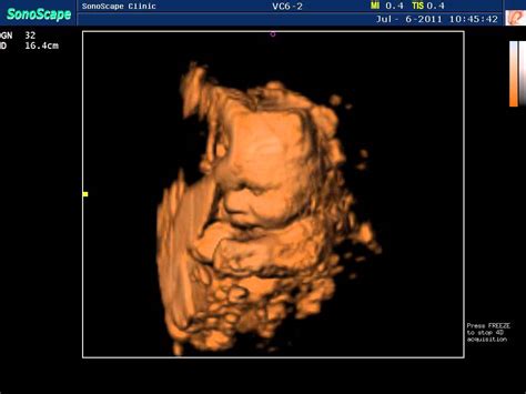 What Do The Colors Mean On Doppler Ultrasound - Infoupdate.org