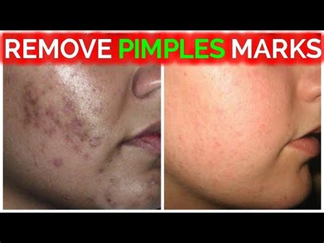 How To Remove Pimples Marks