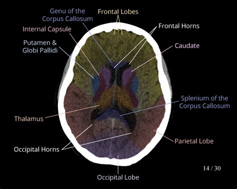 Lobes Of Brain Axial