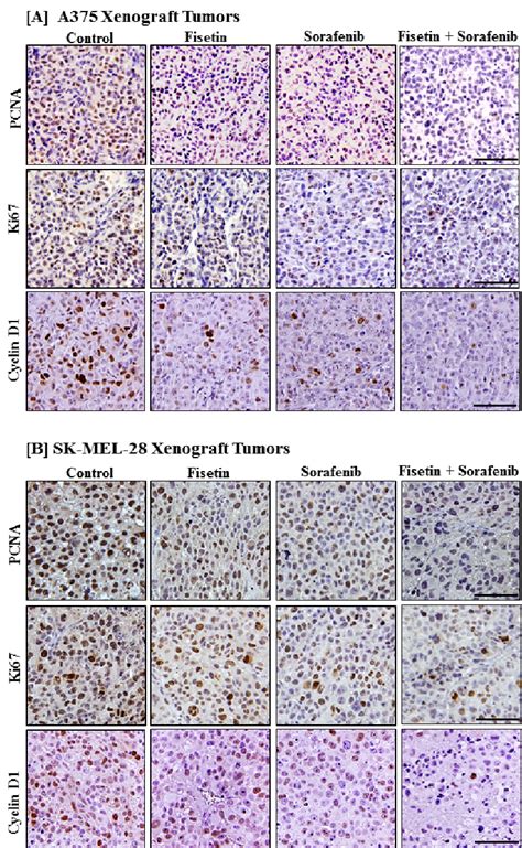 Effects Of Fisetin Sorafenib And Their Combination On Markers Of