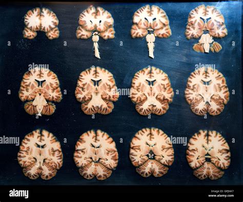 Plastinate, cross sections through human brain, Body Worlds, Menschen Museum, Berlin, Germany ...