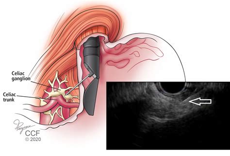 Endoscopic Ultrasonography An Inside View Cleveland Clinic Journal