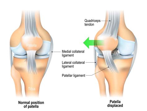 Patellar Dislocation Injury Kneecap Instability Orthopedic Knee