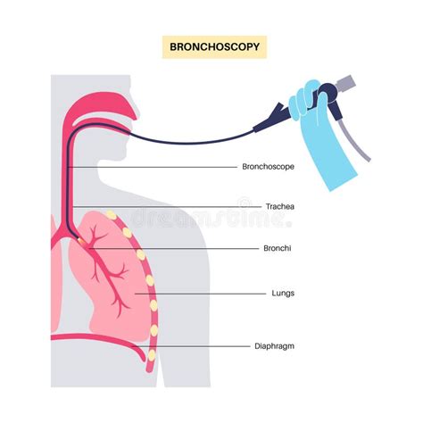 Biopsy Procedure Stock Illustrations – 255 Biopsy Procedure Stock ...