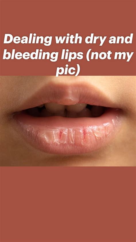 Get Rid Of Chapped Lips Fast Using These 11 Home Remedies Artofit