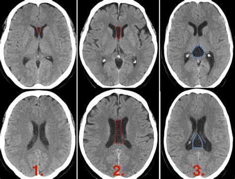 Cavum Septum Pellucidum Cavum Vergae Y Cavum Veli Interpositi Ct