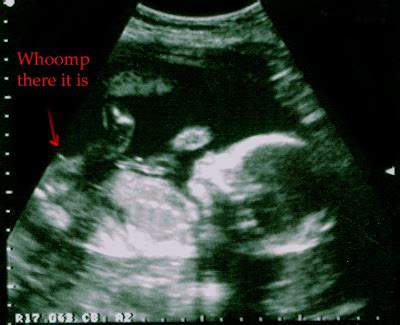 keseper: 3d ultrasound 20 weeks boy