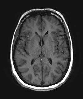 Radiopaedia Case Pericallosal Lipoma Id Study Nc Commons