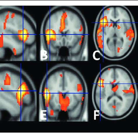 Pdf Resting State Fmri A Review On Methods In Resting State