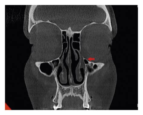 Detection of Haller cell in coronal view CBCT. (a) No Haller cell is ...