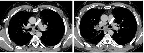 Case 1 Axial Section Thoracic Ct Scan After Pdc Injection The Download Scientific