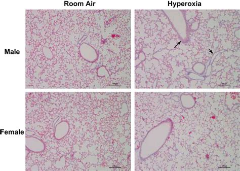 Sex Specific Differences In Neonatal Hyperoxic Lung Injury American