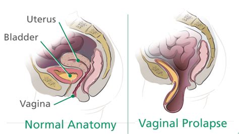 Pelvic Floor Prolapse Surgery Recovery Time Review Home Co