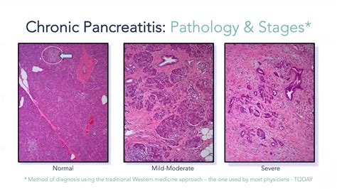 Chronic Pancreatitis Histology