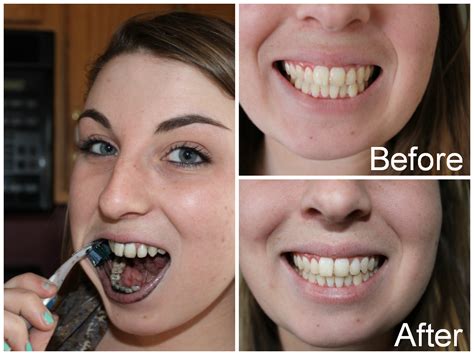 Whiten Teeth In 5 Minutes Break An Activated Charcoal Capsule In Half