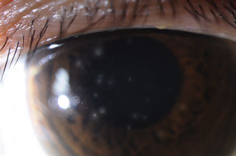 Adenoviral Keratoconjunctivitis Survey Of Ophthalmology