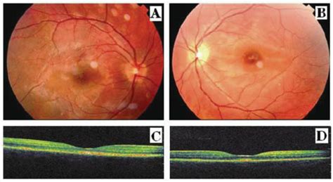 Fundus Photographs Show Complete Reattachment Of Retina Retinal